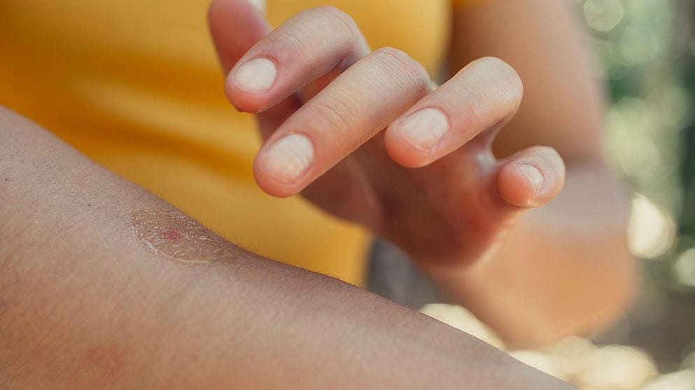 treatment_burns_and_bites_lls